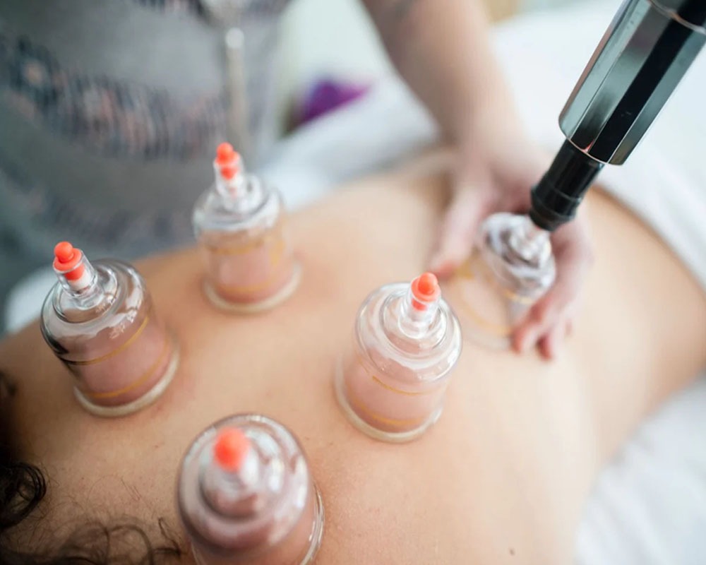 Cupping Therapy