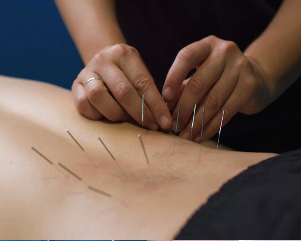 Dry Needling